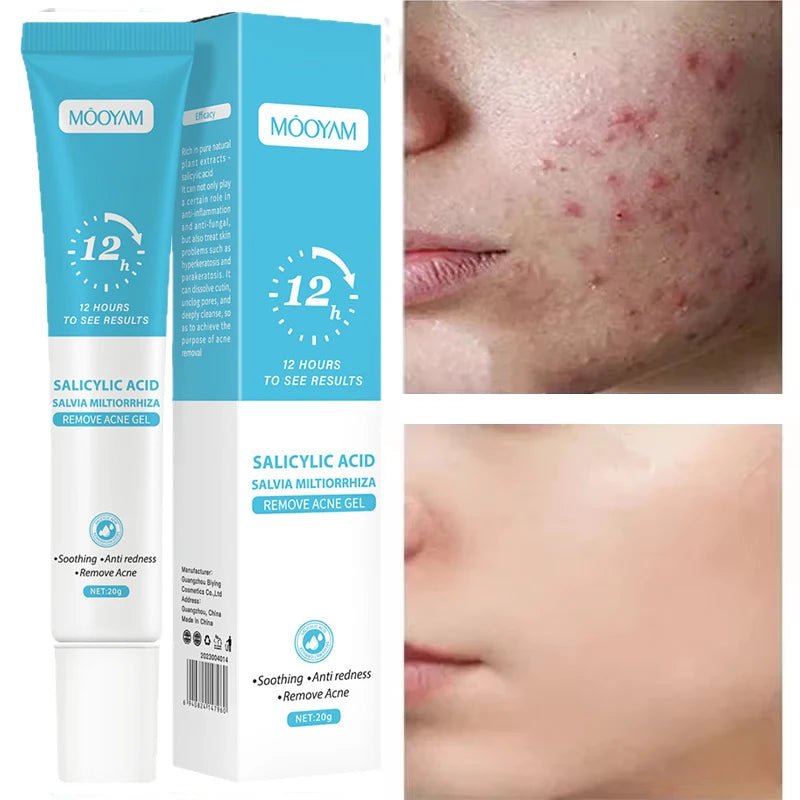 Anti - Acne Face Cream – Pore - Refining & Oil - Control Treatment for Clearer Skin - CosmétiquebyLyria