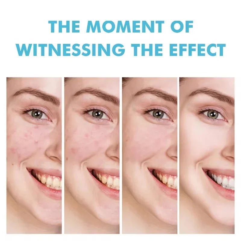 Anti - Acne Face Cream – Pore - Refining & Oil - Control Treatment for Clearer Skin - CosmétiquebyLyria